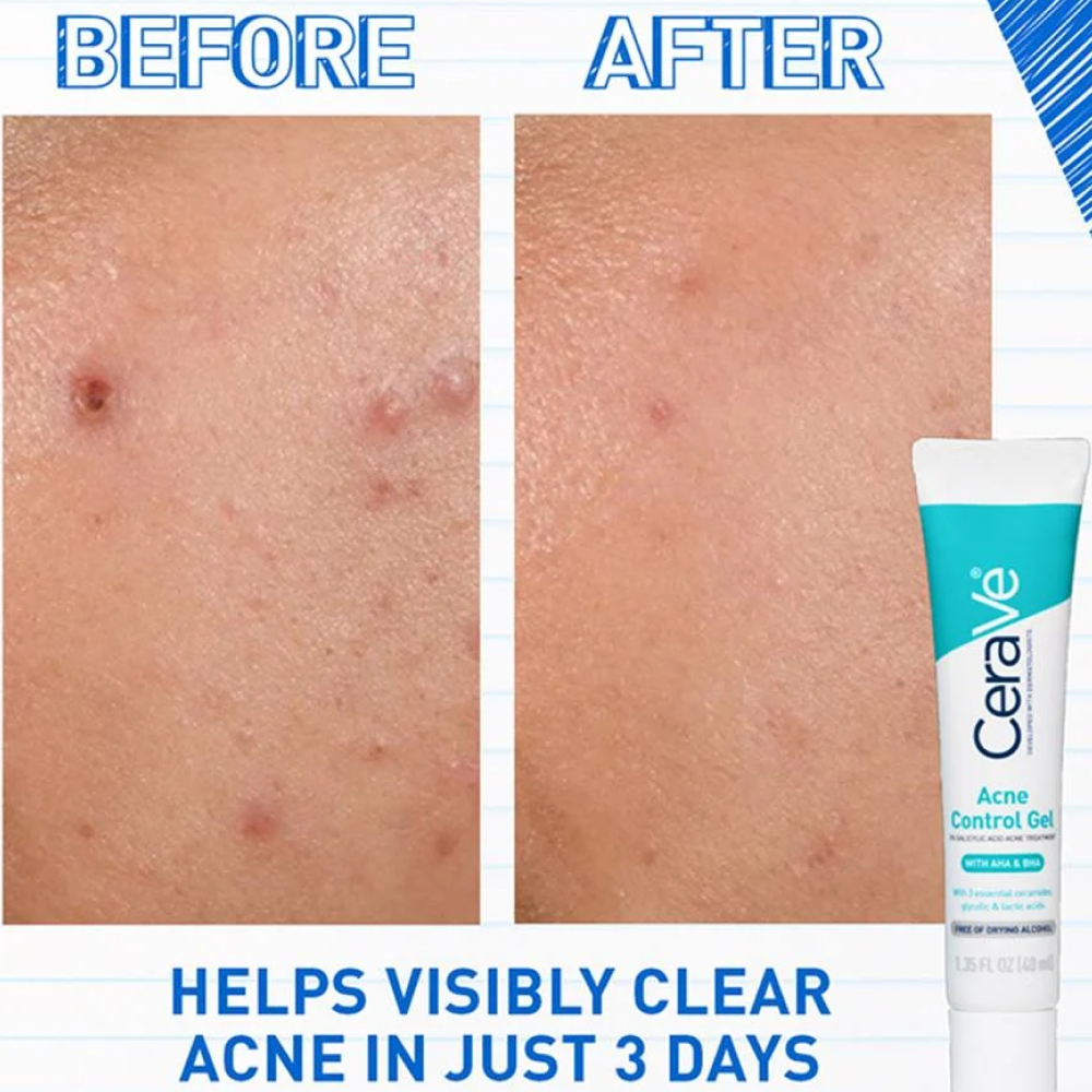 Cerave Acne Control Gel 40ml-Exfoliator-Aladin Beauty